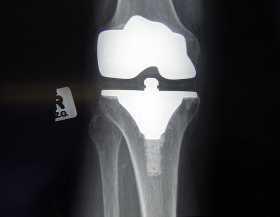 Joint Strength - Knee Replacement